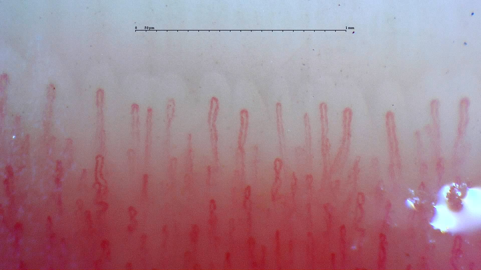 Capilaroscopia - ejemplo 2