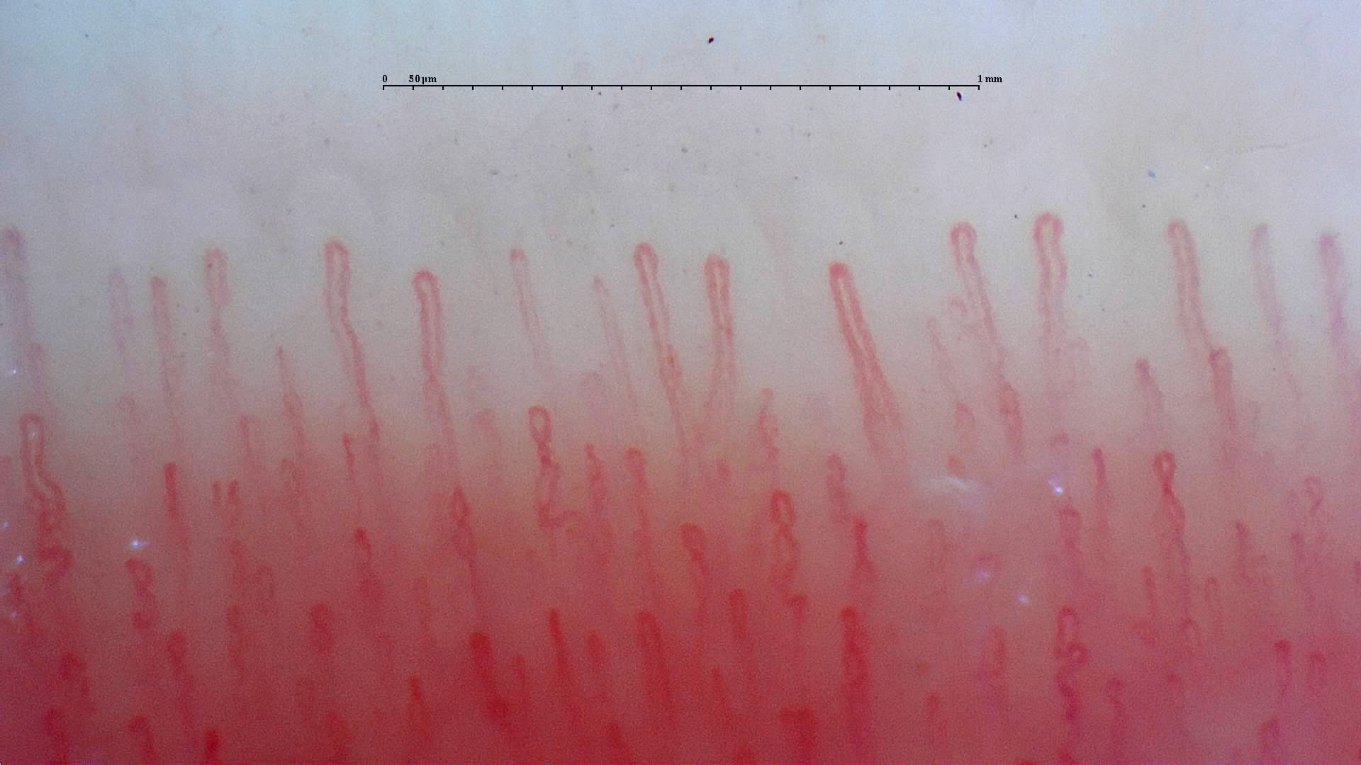 Capilaroscopia - ejemplo 3